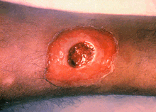 lesion producida por la difteria