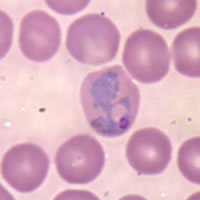 Glóbulo rojo infectado por la malaria