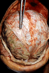 autopsia de una cabeza abierta donde se ven los efectos de la meningitis